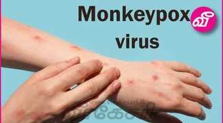 thumb_Monkeypox-case-detected-from-Sri-L